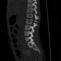 Chance fracture with duodenal and pancreatic lacerations (Radiopaedia 43477-50042 Sagittal bone window 7).jpg