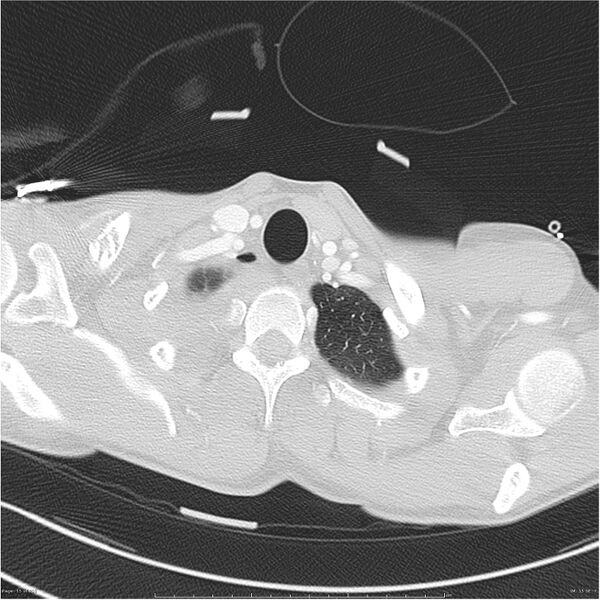 File:Chest and abdomen multi-trauma (Radiopaedia 26294-26425 lung window 15).jpg