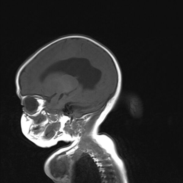 File:Chiari III malformation with occipital encephalocele (Radiopaedia 79446-92559 Sagittal T1 8).jpg