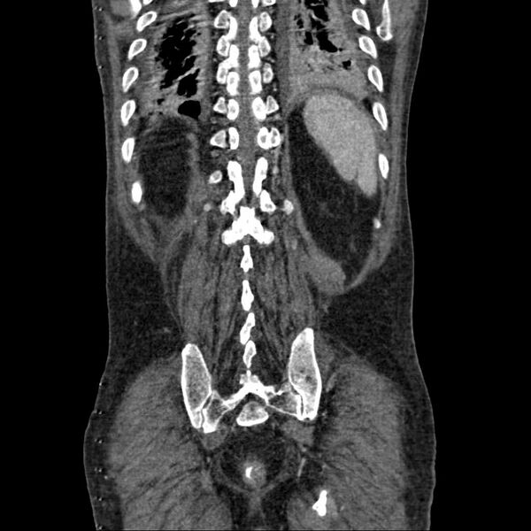 File:Cholangitis and abscess formation in a patient with cholangiocarcinoma (Radiopaedia 21194-21100 C 17).jpg