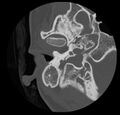 Cholesteatoma (Radiopaedia 20296-20217 bone window 14).jpg