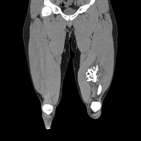 File:Chondrosarcoma arising from exostosis (Radiopaedia 59996-67507 Coronal soft tissue 9).jpg