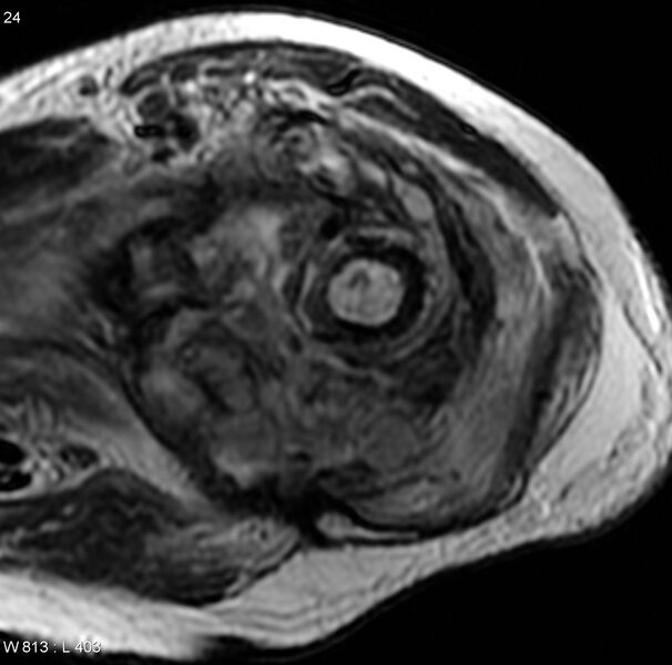 File:Chondrosarcoma with pathological fracture - femur (Radiopaedia 6174-7629 Axial T2 1).jpg