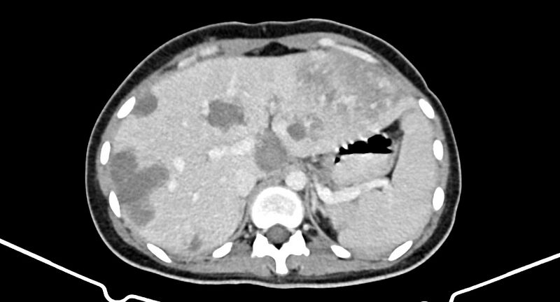 File:Choriocarcinoma liver metastases (Radiopaedia 74768-85766 A 61).jpg