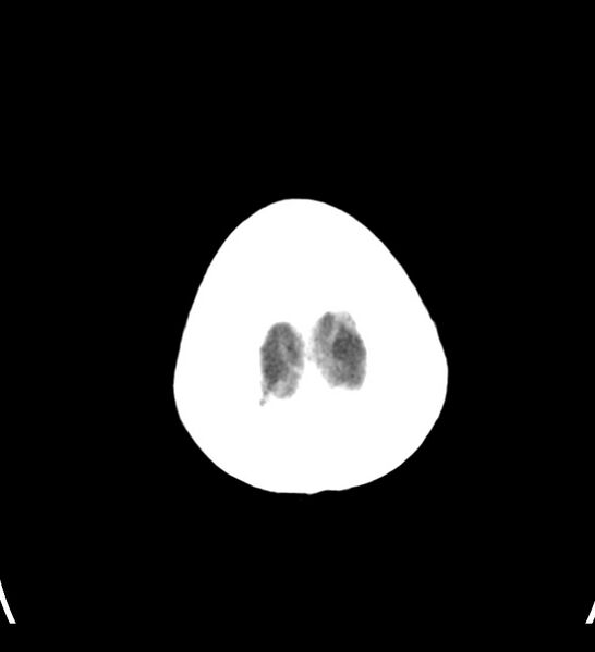 File:Choroid plexus xanthogranuloma (Radiopaedia 91271-108874 Axial non-contrast 30).jpg