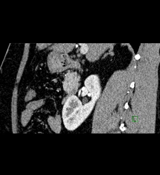 File:Chromophobe renal cell carcinoma (Radiopaedia 84286-99573 F 105).jpg