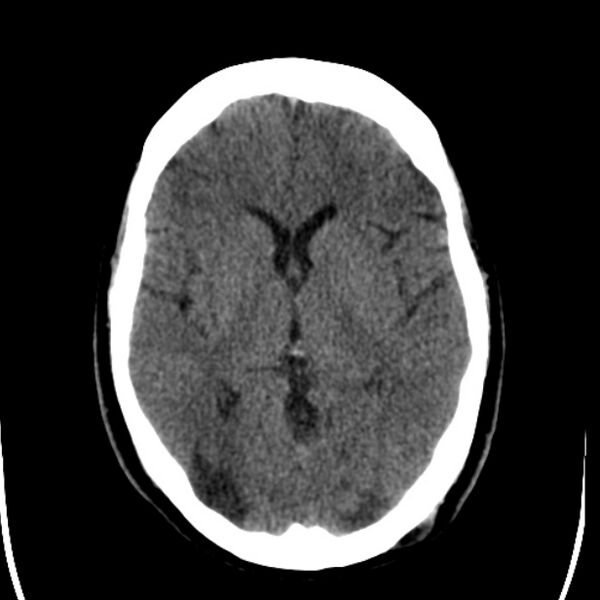 File:Chronic bilateral occipital lobe infarcts (Radiopaedia 31276-31996 Axial non-contrast 21).jpg