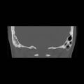 Chronic otomastoiditis (Radiopaedia 27138-27309 Coronal bone window 25).jpg