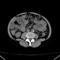 Chronic pancreatitis (Radiopaedia 23132-23172 Axial non-contrast 47).jpg