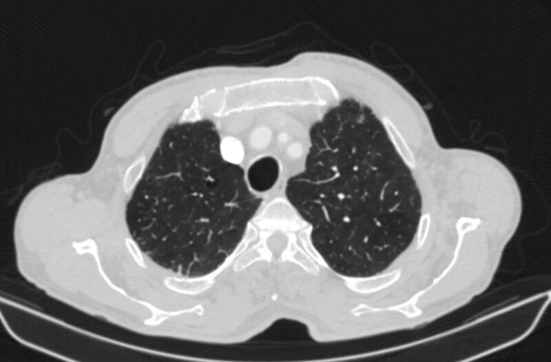 File:Chronic pulmonary embolism (Radiopaedia 91241-108843 Axial lung window 16).jpg