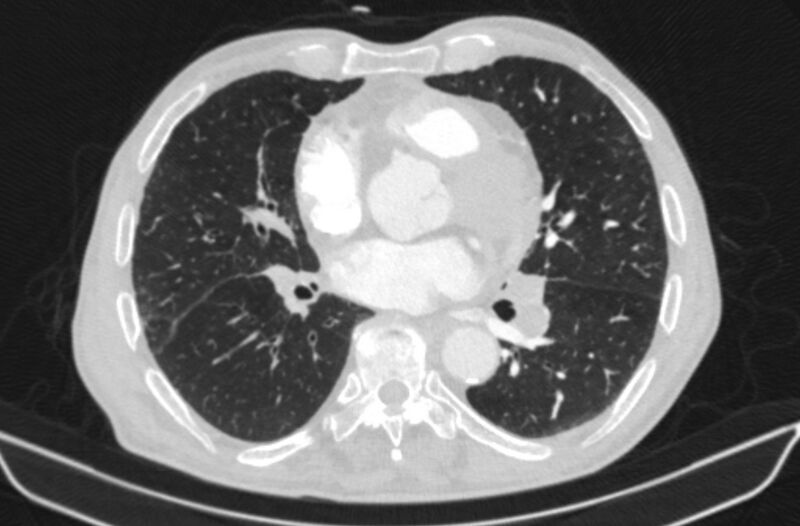 File:Chronic pulmonary embolism (Radiopaedia 91241-108843 Axial lung window 53).jpg