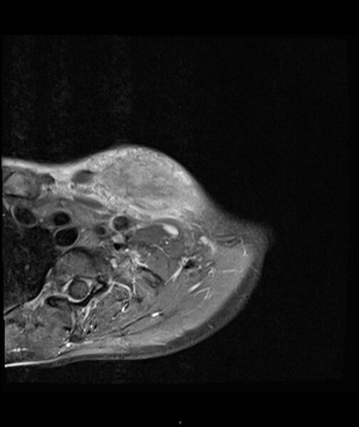 File:Chronic reactive multifocal osteomyelitis (CRMO) - clavicle (Radiopaedia 56406-63071 Axial T1 C+ fat sat 6).jpg