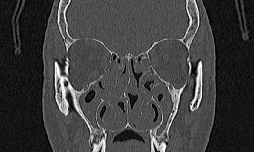Chronic rhinosinusitis (Radiopaedia 65079-74075 Coronal bone window 38).jpg