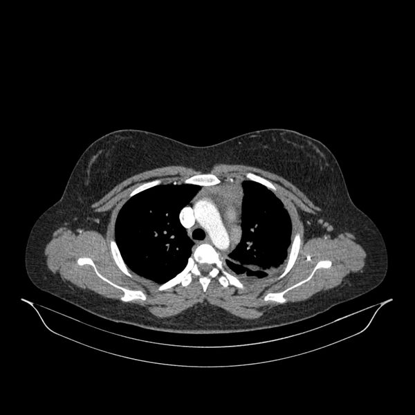 File:Chronic thromboembolic pulmonary hypertension (CTEPH) (Radiopaedia 74597-85532 Axial C+ CTPA 114).jpg
