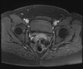 Class II Mullerian duct anomaly- unicornuate uterus with rudimentary horn and non-communicating cavity (Radiopaedia 39441-41755 Axial T1 fat sat 94).jpg