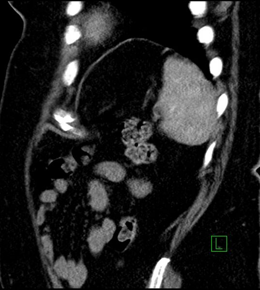 File:Clear cell renal cell carcinoma (Radiopaedia 85004-100537 D 11).jpg