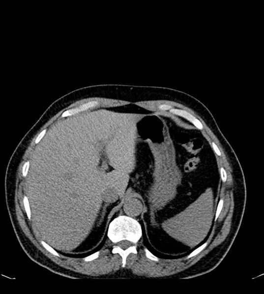 File:Clear cell renal cell carcinoma (Radiopaedia 85006-100539 Axial non-contrast 22).jpg
