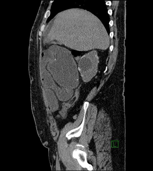 File:Closed-loop small bowel obstruction-internal hernia (Radiopaedia 78439-91096 C 110).jpg