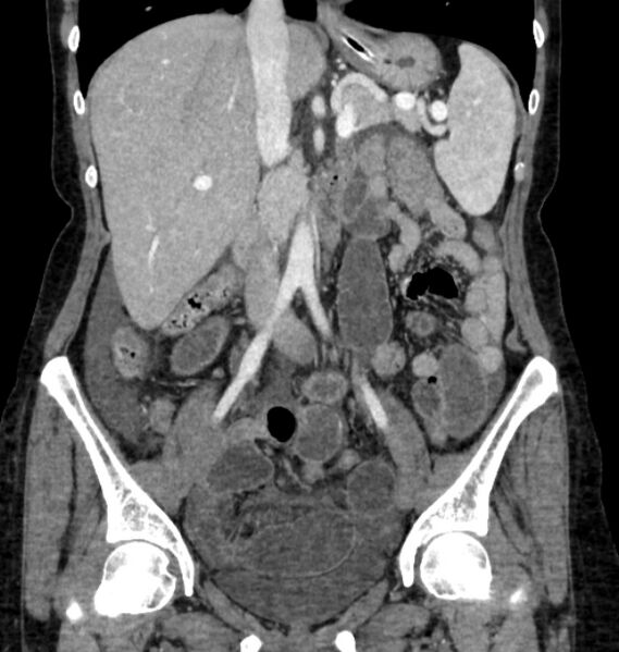 File:Closed loop small bowel obstruction (Radiopaedia 71211-81508 B 56).jpg
