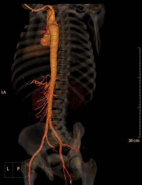 File:Coarctation of the aorta (Radiopaedia 49784-55050 3D VRT 14).jpg