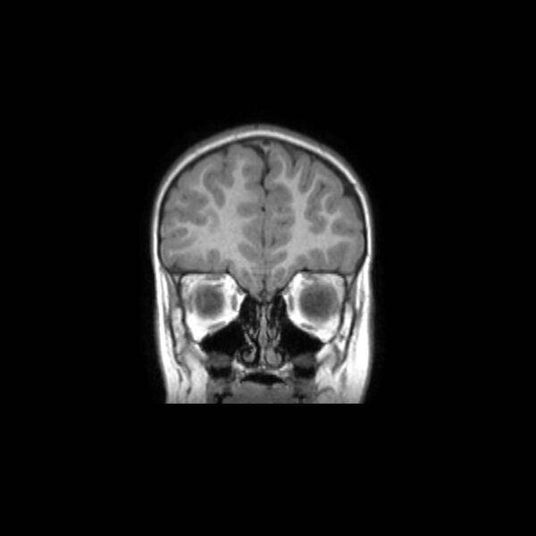 File:Cochlear nerve aplasia - unilateral (Radiopaedia 87910-104413 Coronal T1 11).jpg