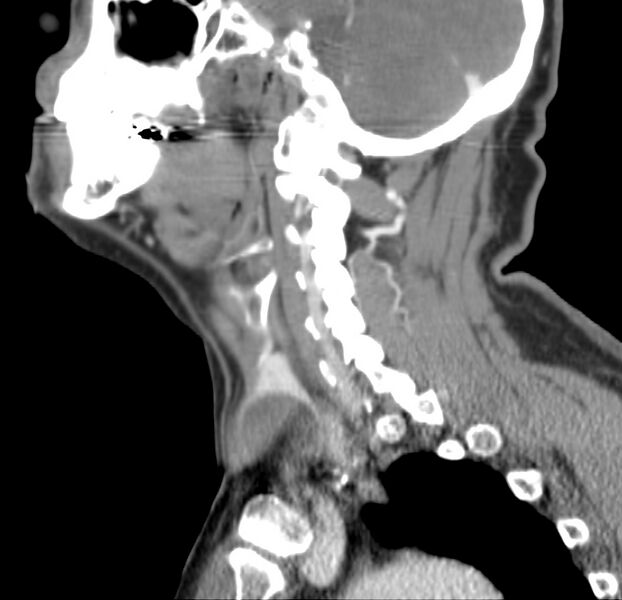 File:Colloid cyst of thyroid (Radiopaedia 22897-22923 Sagittal C+ delayed 37).jpg