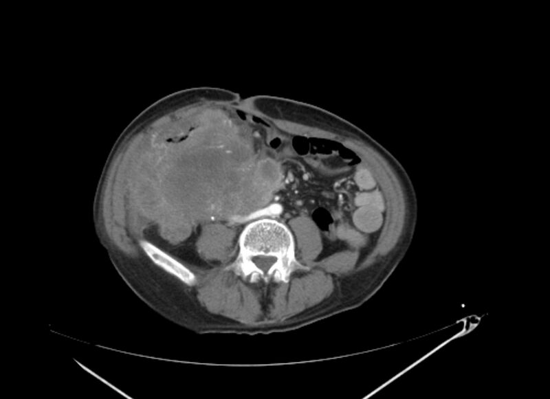 File:Colon cancer mimicking renal cell carcinoma (Radiopaedia 28986-29335 B 46).jpg