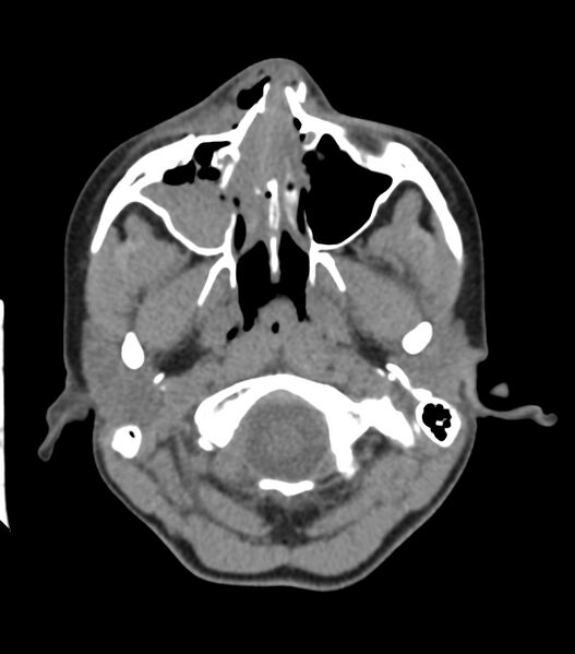 File:Nasoorbitoethmoid fracture (Radiopaedia 90044-107205 Axial non-contrast 130).jpg