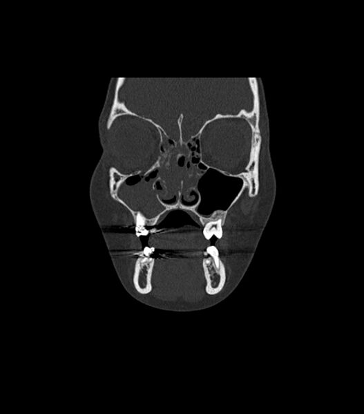 File:Nasoorbitoethmoid fracture (Radiopaedia 90044-107205 Coronal bone window 43).jpg