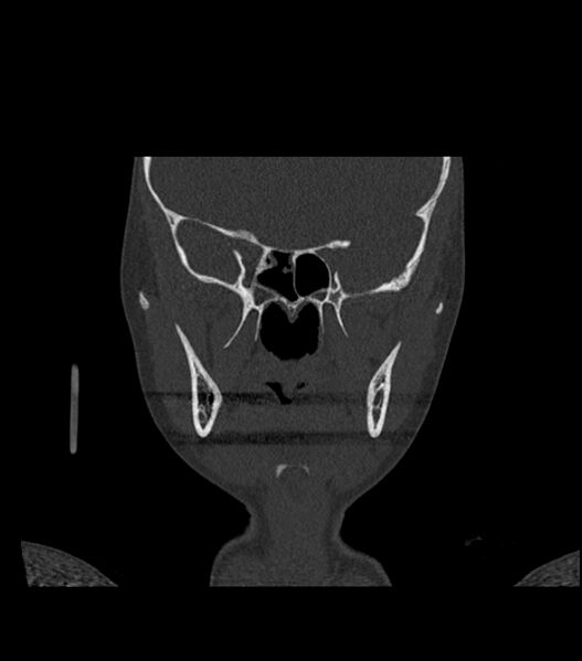 File:Nasoorbitoethmoid fracture (Radiopaedia 90044-107205 Coronal bone window 69).jpg