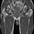 Necrotizing epididymo-orchitis with intra-testicular abscess (Radiopaedia 29397-29860 Coronal T1 C+ 17).jpg