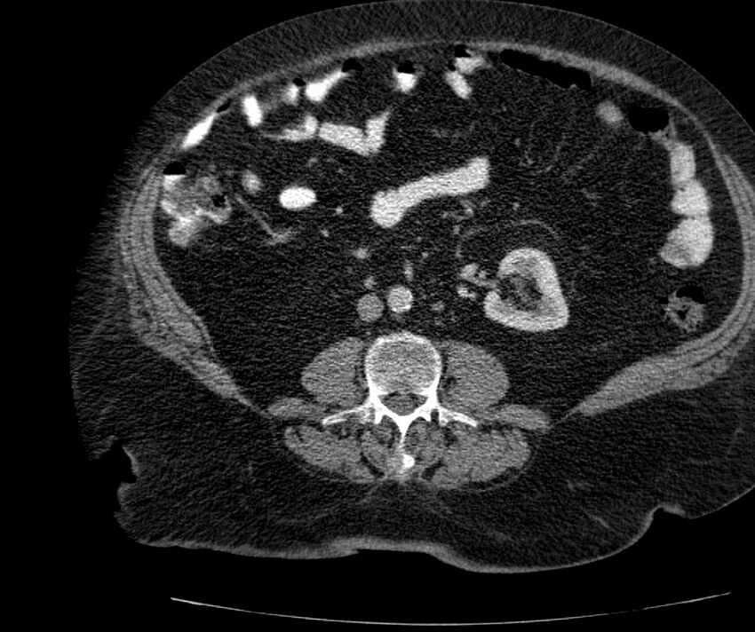 Nephroptosis with inguinal hernia containing perirenal fat (Radiopaedia 56632-63391 C 190).jpg