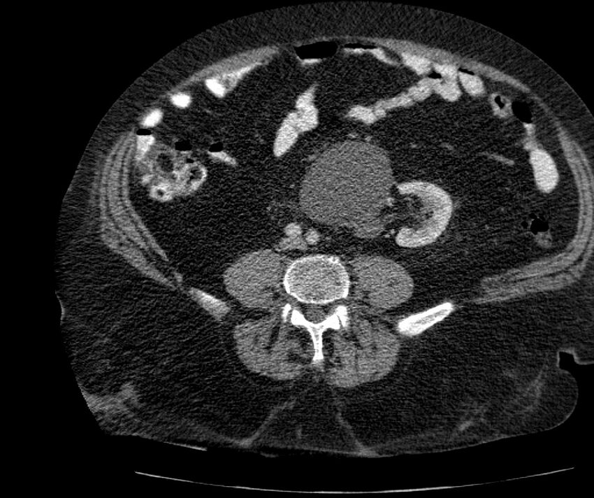 Nephroptosis with inguinal hernia containing perirenal fat (Radiopaedia 56632-63391 C 217).jpg