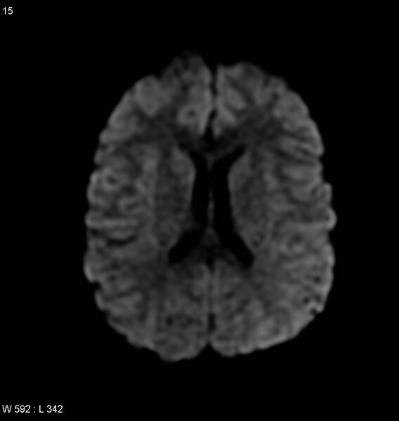 File:Neurocysticercosis (Radiopaedia 4767-6773 Axial DWI 1).jpg