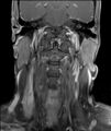 Neurofibromatosis type 1 (Radiopaedia 80355-93740 I 3).jpg