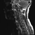 Neurofibromatosis type 1 (Radiopaedia 80355-93740 Sagittal T2 1).jpg