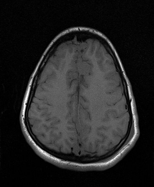 File:Neurofibromatosis type 2 (Radiopaedia 66211-75401 Axial T1 21).jpg