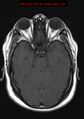 Neuroglial cyst (Radiopaedia 10713-11184 Axial T1 15).jpg