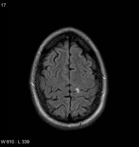 File:Neurosarcoidosis (Radiopaedia 10930-11351 Axial FLAIR 17).jpg