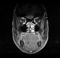 Non-Hodgkin lymphoma - parotid gland (Radiopaedia 71531-81890 H 7).jpg