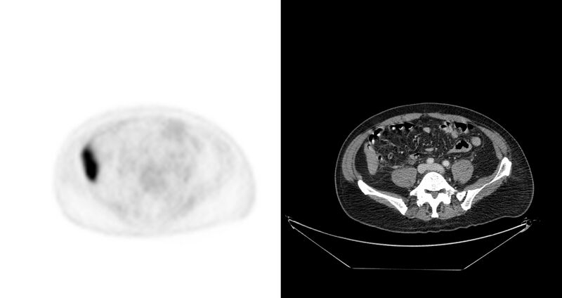 File:Non-Hodgkin lymphoma involving seminal vesicles with development of interstitial pneumonitis during Rituximab therapy (Radiopaedia 32703-33675 axial PET CT 19).jpg
