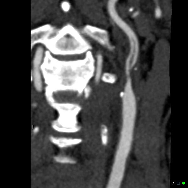 File:Non-occlusive intraluminal internal carotid artery thrombus (Radiopaedia 37751-39658 A 36).jpg