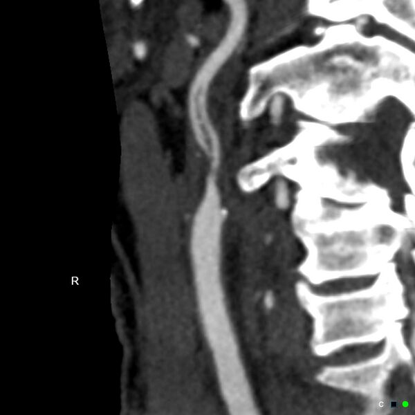 File:Non-occlusive intraluminal internal carotid artery thrombus (Radiopaedia 37751-39658 A 70).jpg