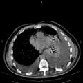 Non Hodgkin lymphoma in a patient with ankylosing spondylitis (Radiopaedia 84323-99621 Axial non-contrast 19).jpg