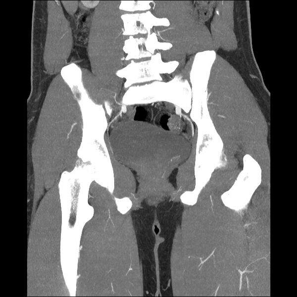 File:Normal CT angiogram of pelvis (Radiopaedia 45390-49430 B 29).jpg