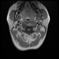 Normal cervical and thoracic spine MRI (Radiopaedia 35630-37156 Axial T1 C+ 29).png