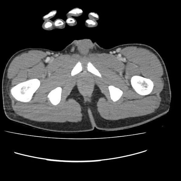File:Normal dual-phase trauma CT chest,abdomen and pelvis (Radiopaedia 48092-52899 A 118).jpg