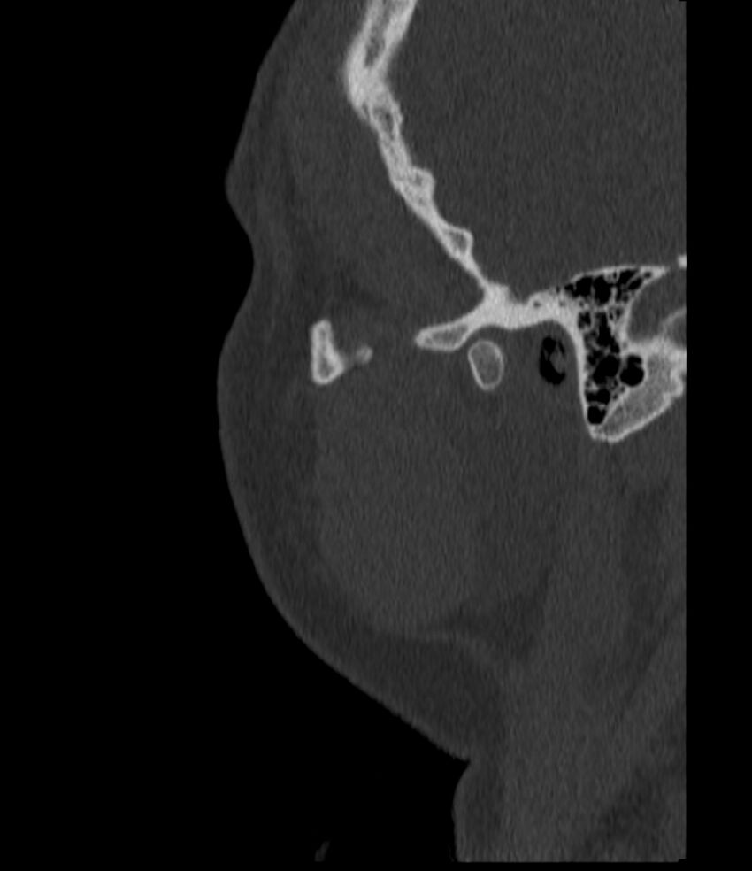 Normal facial bone CT (Radiopaedia 88742-105476 Sagittal bone window 146).jpg