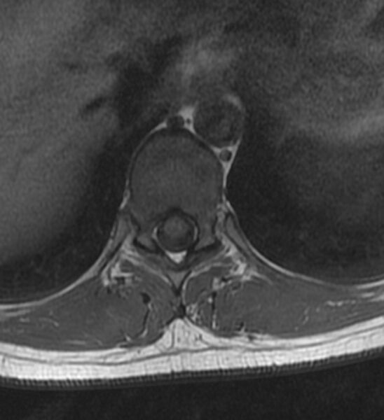 File:Normal thoracic spine MRI (Radiopaedia 41033-43781 Axial T1 14).jpg