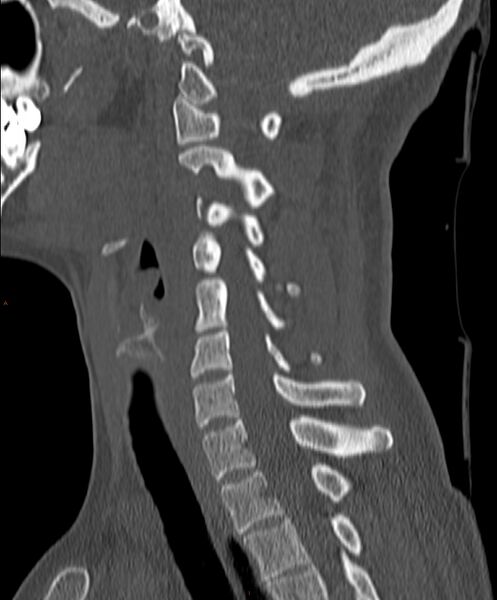 File:Occipital condyle fracture (Radiopaedia 61165-69056 Sagittal bone window 16).jpg